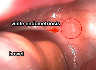 White Endometriosis